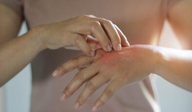 Skleroderma hastalığı sadece cildi değil, hayati organları da etkiliyor